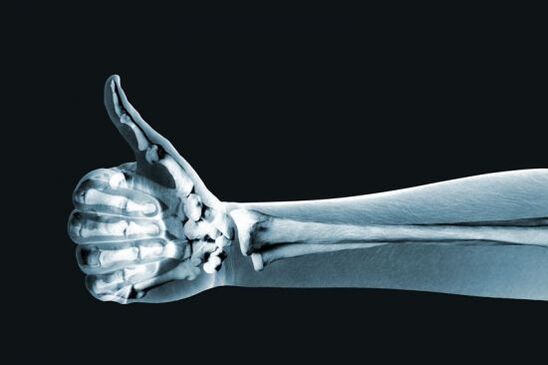 Η ακτινογραφία μπορεί να βοηθήσει στη διάγνωση του πόνου στις αρθρώσεις των δακτύλων
